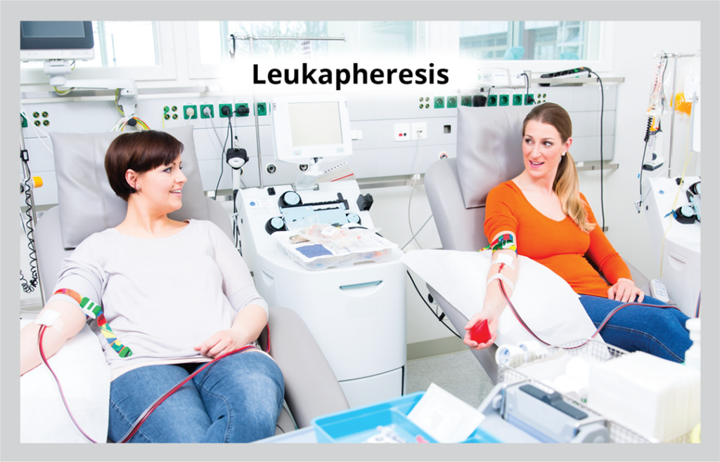 Leukapheresis: using apheresis machinery to separate white blood cells from whole blood