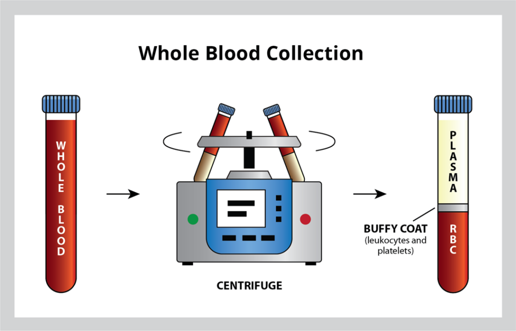 Buffy Coat blood plasma separation